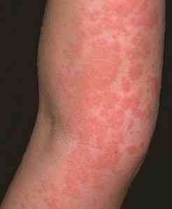Клинические проявления аллергии | Аллергия | Медицинское и ...