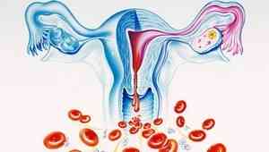 Обильные менструации (меноррагия): причины и симптомы, диагностика ...